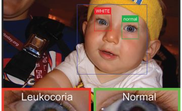 Une application mobile pour détecter les maladies des yeux via des photos